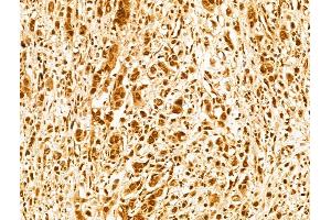 ABIN7094227 and ABIN7098274 at 1/100 staining Human gastric cancer by IHC-P. (FBXW11 Antikörper  (C-Term))