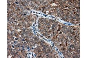 Immunohistochemical staining of paraffin-embedded Adenocarcinoma of ovary tissue using anti-NIT1 mouse monoclonal antibody. (Nitrilase 1 Antikörper)