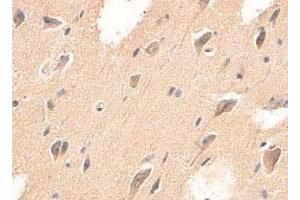 Immunohistochemical staining of formalin-fixed paraffin-embedded human brain tissue with ADAMTS4 polyclonal antibody  at 1 : 200 dilution. (ADAMTS4 Antikörper  (C-Term))