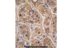 Formalin-fixed and paraffin-embedded human hepatocarcinomareacted with AKR1A1 polyclonal antibody , which was peroxidase-conjugated to the secondary antibody, followed by AEC staining. (AKR1A1 Antikörper  (C-Term))