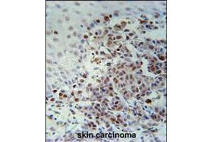 XRCC1 Antibody immunohistochemistry analysis in formalin fixed and paraffin embedded human skin carcinoma followed by peroxidase conjugation of the secondary antibody and DAB staining.