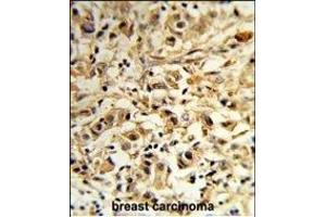Forlin-fixed and paraffin-embedded hun breast carcino reacted with T2B Antibody (N-term), which was peroxidase-conjugated to the secondary antibody, followed by DAB staining. (MAT2B Antikörper  (N-Term))