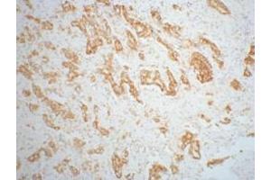 IHC staining of mouse prostate adenocarcinoma tissue, diluted at 1:200. (AMACR Antikörper)