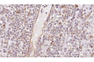 ABIN6273205 at 1/100 staining Human lymph cancer tissue by IHC-P. (CCBL1 Antikörper  (Internal Region))