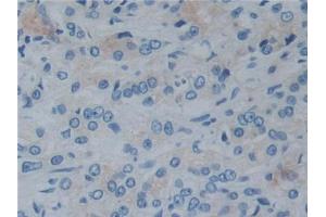 DAB staining on IHC-P;;Samples: Human Prostate cancer Tissue (Reelin Antikörper  (AA 2398-2608))