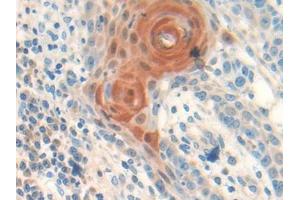 DAB staining on IHC-P; Samples: Human Skin cancer Tissue (Follistatin Antikörper  (AA 35-283))