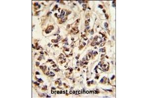 ATP6V1A Antibody (Center) (ABIN653735 and ABIN2843040) IHC analysis in formalin fixed and paraffin embedded breast carcinoma followed by peroxidase conjugation of the secondary antibody and DAB staining. (ATP6V1A Antikörper  (AA 441-468))