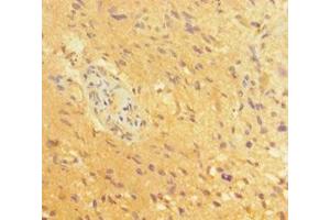 Immunohistochemistry of paraffin-embedded human glioma using ABIN7164055 at dilution of 1:100 (POU3F2 Antikörper  (AA 1-443))