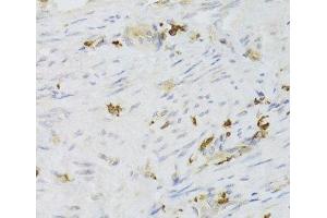 Immunohistochemistry of paraffin-embedded Human adenomyosis using LSP1 Polyclonal Antibody at dilution of 1:100 (40x lens). (LSP1 Antikörper)
