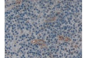 Detection of IL2Ra in Human Skin cancer Tissue using Polyclonal Antibody to Interleukin 2 Receptor Alpha (IL2Ra) (CD25 Antikörper  (AA 22-213))