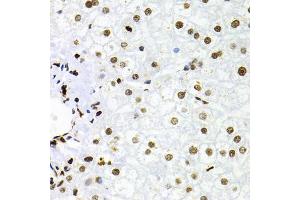 Immunohistochemistry of paraffin-embedded human liver injury using NFKB2 Antibody (ABIN1873900) at dilution of 1:100 (40x lens). (NFKB2 Antikörper)