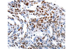 Immunohistochemistry of Human ovarian cancer using MUTYH Polyclonal Antibody at dilution of 1:60 (MUTYH Antikörper)