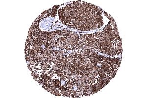 Vulva Squamous cell carcinoma showing strong HLA DR immunostaining in tumor cells (Rekombinanter HLA-DRA Antikörper)