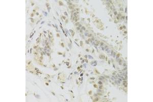 Immunohistochemistry of paraffin-embedded human breast using PRPF3 Antibody (ABIN5973192) at dilution of 1/100 (40x lens). (PRPF3 Antikörper)