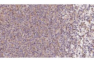 ABIN6273213 at 1/100 staining Human lymph cancer tissue by IHC-P. (COQ9 Antikörper  (Internal Region))
