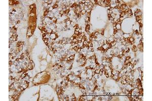 Immunoperoxidase of monoclonal antibody to SERPINA3 on formalin-fixed paraffin-embedded human ovary, clear cell carcinoma. (SERPINA3 Antikörper  (AA 25-423))
