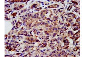 IHC image of ABIN7169389 diluted at 1:200 and staining in paraffin-embedded human pancreatic cancer performed on a Leica BondTM system. (PON3 Antikörper  (AA 269-335))