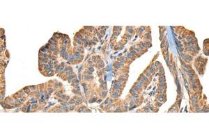 Immunohistochemistry of paraffin-embedded Human thyroid cancer tissue using SLAMF7 Polyclonal Antibody at dilution of 1:30(x200) (SLAMF7 Antikörper)