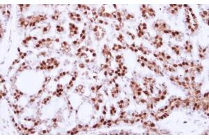 IHC-P Image Immunohistochemical analysis of paraffin-embedded human breast cancer, using CDC25C, antibody at 1:250 dilution. (CDC25C Antikörper)