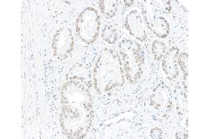 Immunohistochemistry (IHC) image for anti-AT Rich Interactive Domain 1A (SWI-Like) (ARID1A) (AA 750-800) antibody (ABIN7795677) (Rekombinanter ARID1A Antikörper  (AA 750-800))