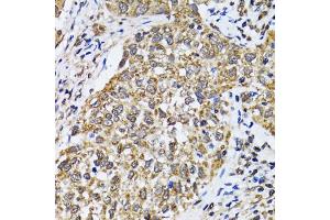 Immunohistochemistry of paraffin-embedded human lung cancer using TP53 antibody (ABIN5973383) at dilution of 1/100 (40x lens). (p53 Antikörper)