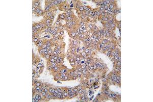 Formalin-fixed and raffin-embedded human prostata carcinoma tissue reacted with K4 antibody (N-term), which was peroxidase-conjugated to the secondary antibody, followed by DAB staining. (PAK4 Antikörper  (N-Term))