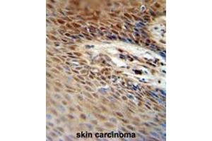 ZNF324B antibody (C-term) immunohistochemistry analysis in formalin fixed and paraffin embedded human skin carcinoma followed by peroxidase conjugation of the secondary antibody and DAB staining.