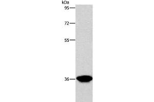 Western Blot analysis of Human liver cancer tissue using AKR1D1 Polyclonal Antibody at dilution of 1:650 (AKR1D1 Antikörper)