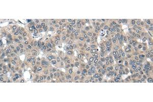 Immunohistochemistry of paraffin-embedded Human liver cancer tissue using CARD16 Polyclonal Antibody at dilution of 1:55(x200) (CARD16 Antikörper)