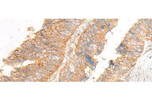 Immunohistochemistry of paraffin-embedded Human colorectal cancer tissue using GLIS1 Polyclonal Antibody at dilution of 1:50(x200) (GLIS1 Antikörper)