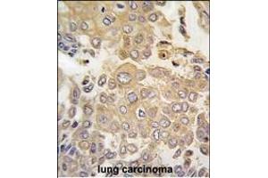 Forlin-fixed and paraffin-embedded hun lung carcino tissue reacted with PK4 antibody (N-term) (ABIN391465 and ABIN2837846) , which was peroxidase-conjugated to the secondary antibody, followed by DAB staining. (MAPK4 Antikörper  (N-Term))