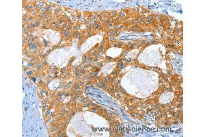 Immunohistochemistry of Human lung cancer using AMHR2 Polyclonal Antibody at dilution of 1:40