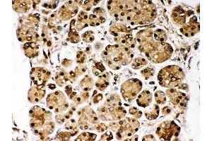 IHC-P: DJ-1 antibody testing of human pancreatic cancer tissue (PARK7/DJ1 Antikörper  (AA 2-189))