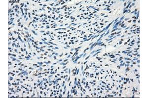 Immunohistochemical staining of paraffin-embedded Adenocarcinoma of colon tissue using anti-FRKmouse monoclonal antibody. (FRK Antikörper)
