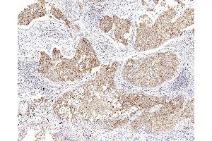 Immunohistochemistry analysis of paraffin-embedded human lung cancer using CYCS Polyclonal Antibody at dilution of 1:1000. (Cytochrome C Antikörper)