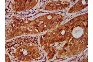 IHC image of ABIN7173860 diluted at 1:500 and staining in paraffin-embedded human cervical cancer performed on a Leica BondTM system.