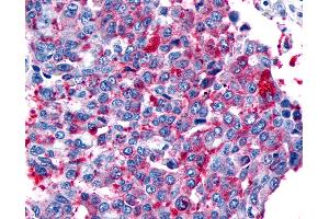 Anti-FZD8 / Frizzled 8 antibody IHC of human Lung, Non-Small Cell Carcinoma. (FZD8 Antikörper  (N-Term))