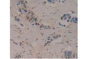 DAB staining on IHC-P Samples:Human Breast Cancer Tissue)