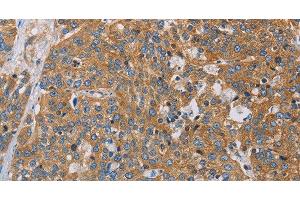 Immunohistochemistry of paraffin-embedded Human esophagus cancer using ACTN4 Polyclonal Antibody at dilution of 1:60 (alpha Actinin 4 Antikörper)