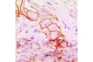Immunohistochemical analysis of CD104 staining in human breast cancer formalin fixed paraffin embedded tissue section.
