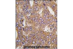 Formalin-fixed and paraffin-embedded human prostata carcinoma tissue reacted with NARS2 antibody , which was peroxidase-conjugated to the secondary antibody, followed by DAB staining. (NARS2 Antikörper  (C-Term))