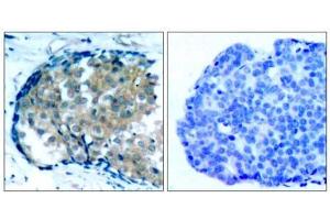 Immunohistochemical analysis of paraffin-embedded human breast carcinoma tissue, using Ezrin (phospho-Tyr353) antibody (E011063). (Ezrin Antikörper  (pTyr353))