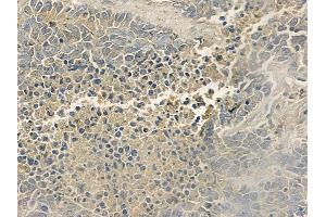 ABIN6255799 and ABIN6277803 at 1/100 staining human large cell lung carcinoma by IHC-P. (ERBB3 Antikörper  (pTyr1289))