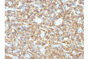 Formalin-fixed, paraffin-embedded human Ewing's Sarcoma stained with CD99 Mouse Monoclonal Antibody (HO36-1. (CD99 Antikörper)