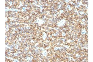 Formalin-fixed, paraffin-embedded human Ewing's Sarcoma stained with CD99 Mouse Monoclonal Antibody (HO36-1.