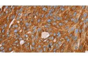 Immunohistochemistry of paraffin-embedded Human breast cancer using PAICS Polyclonal Antibody at dilution of 1:35