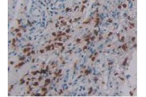 IHC-P analysis of Human Skin Cancer Tissue, with DAB staining. (DEFA4 Antikörper  (AA 23-97))