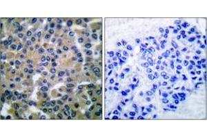 Immunohistochemistry analysis of paraffin-embedded human breast carcinoma tissue, using SYK (Ab-348) Antibody. (SYK Antikörper  (AA 314-363))