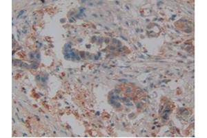IHC-P analysis of Human Pancreas Cancer Tissue, with DAB staining.
