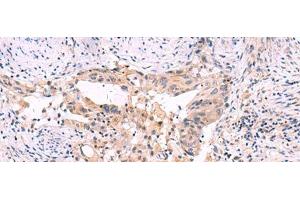 Immunohistochemistry of paraffin-embedded Human cervical cancer tissue using SLC12A5 Polyclonal Antibody at dilution of 1:40(x200) (KCC2 Antikörper)